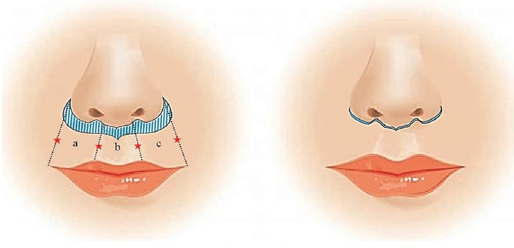 Lip lift procedure