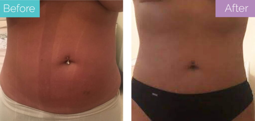 Mini tummy tuck before and after