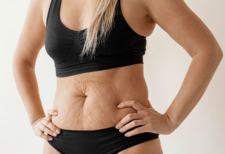mini tummy tuck