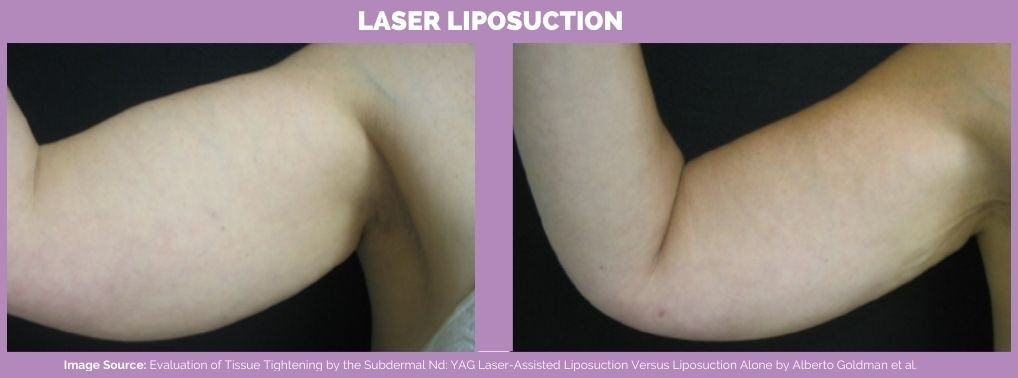 Arm laser assisted liposuction