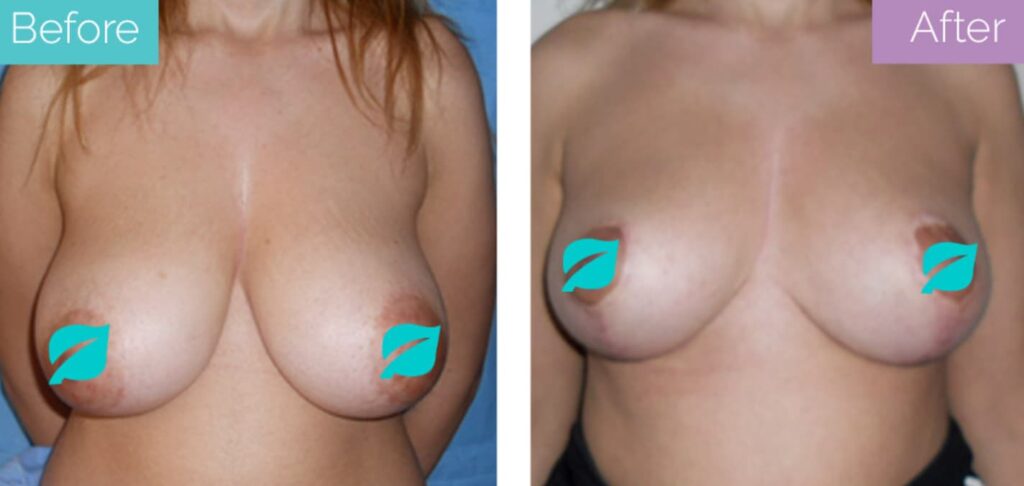 Breast lift with areola reduction