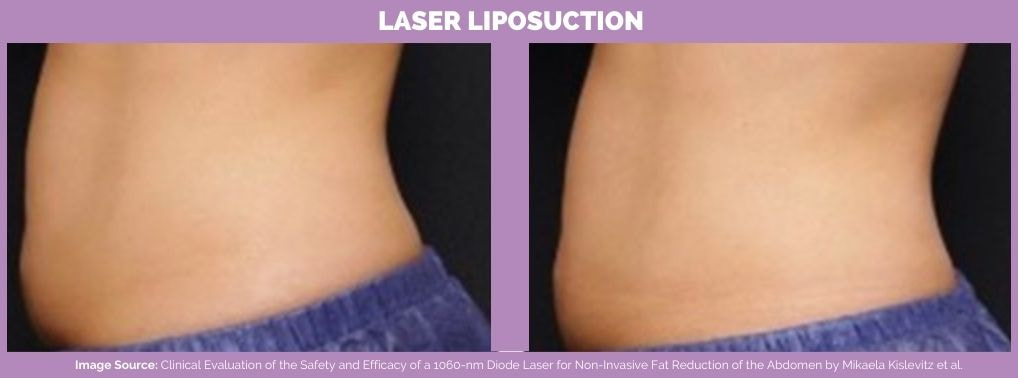 Laser liposuction before and after