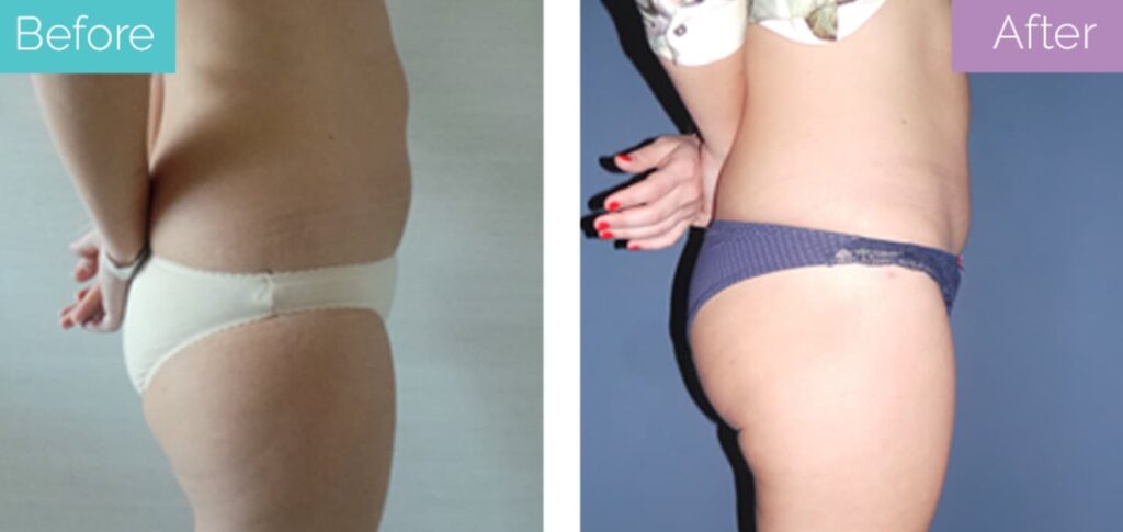 Liposuction with BBL