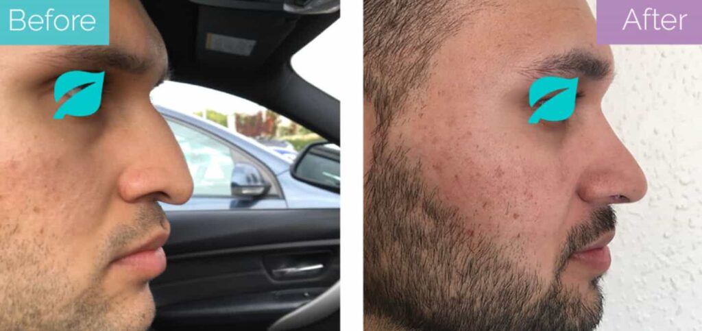 Male nose job before and after