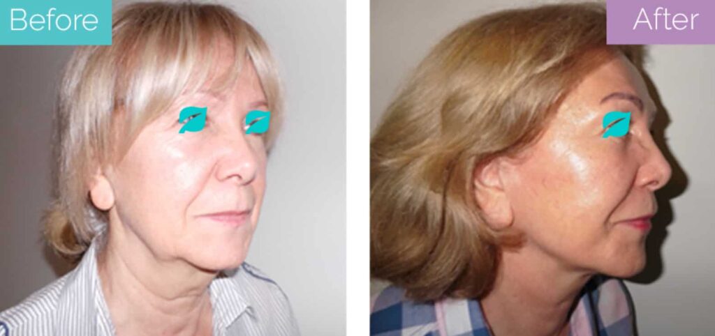 Surgical facelift