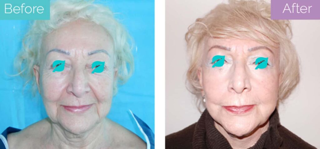 facelift with neck lift