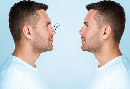 nose job men