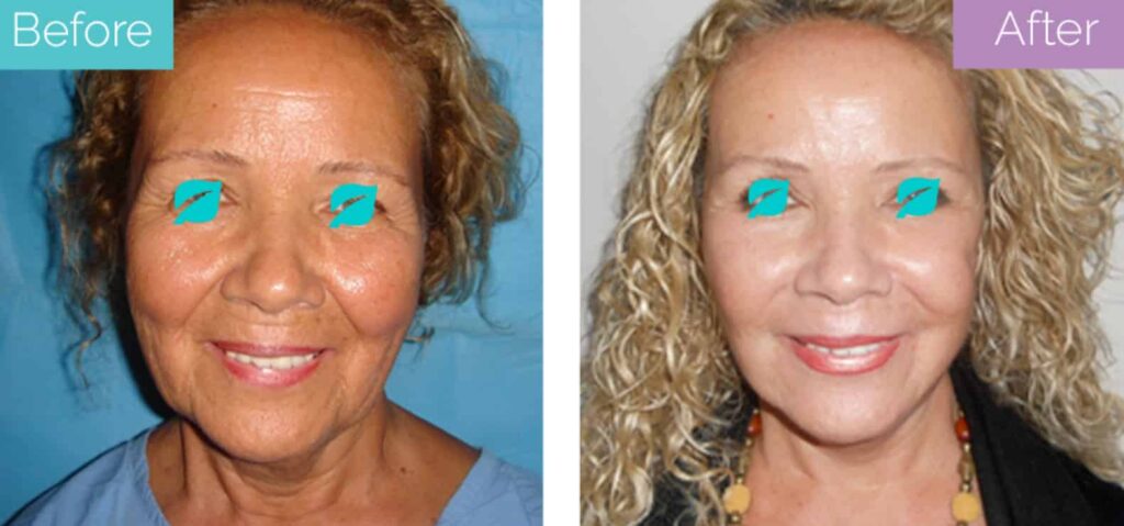 Surgical facelift before and after