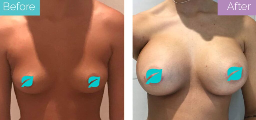 Breast implant surgery
