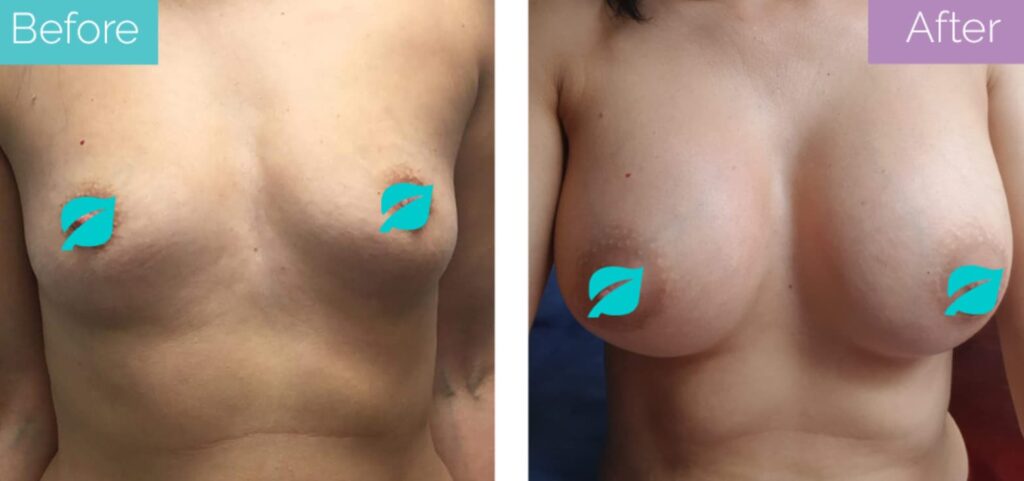 Breasy augmentation for wide boobs