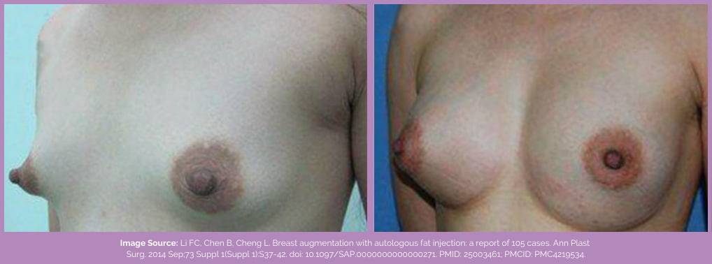 Fat transfer to tuberous breasts