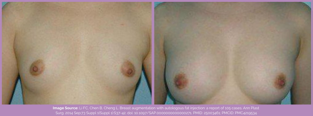 Fat transfers to breasts before and after