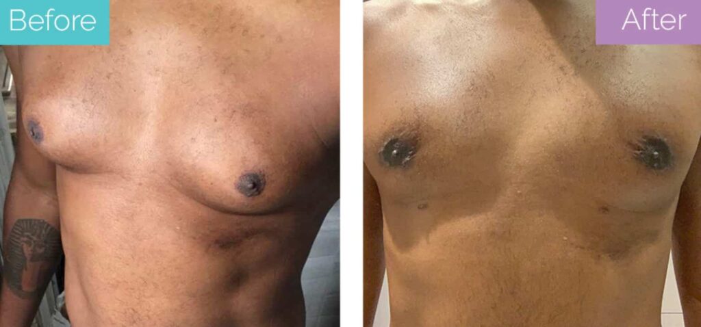 Before and after gynecomastia