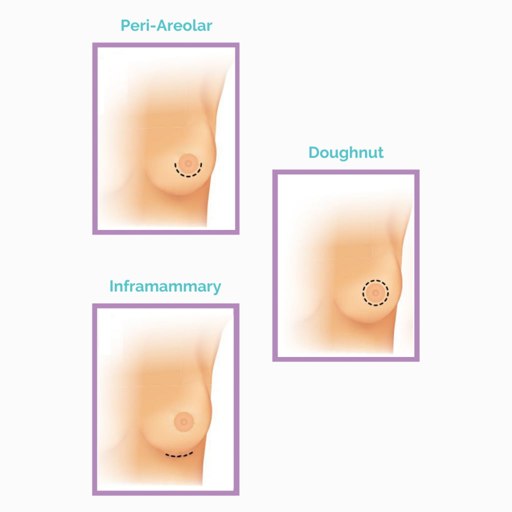 Breast Enlargement Incisions