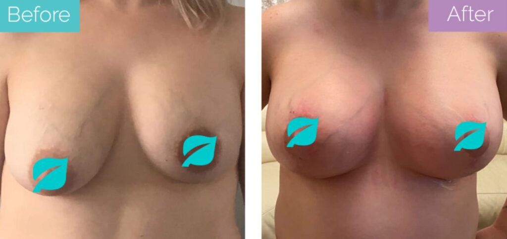 Breast implant replacement
