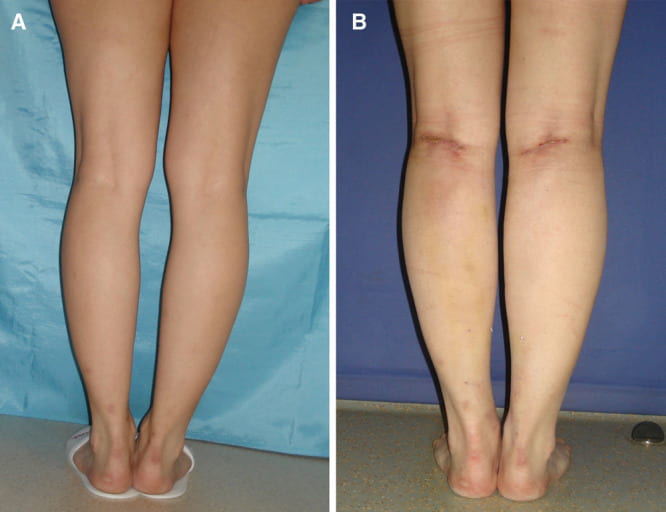 Calf implants before and after