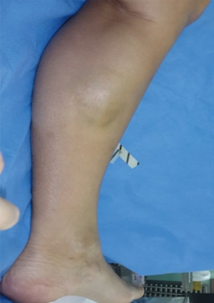 Capsular contracture afetr calf implants