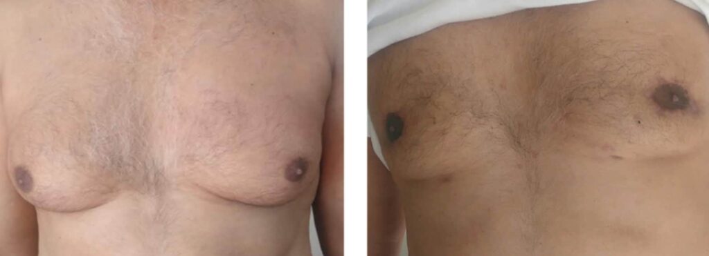Gynecomastia surgery scars