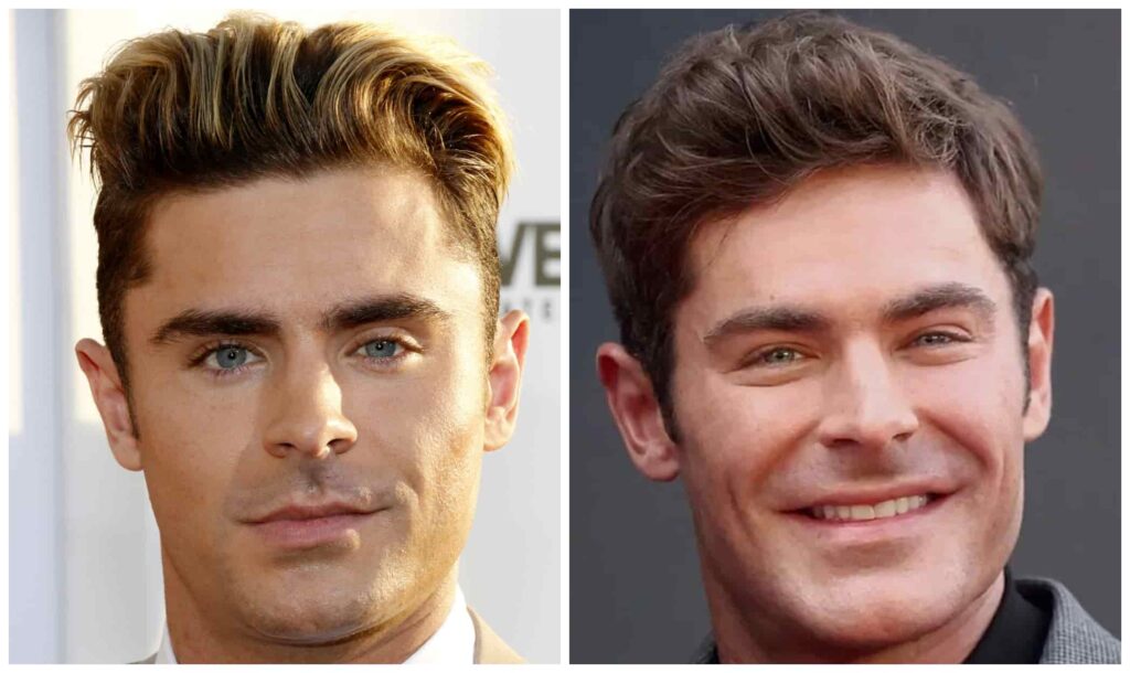 Zac Efron face before and after