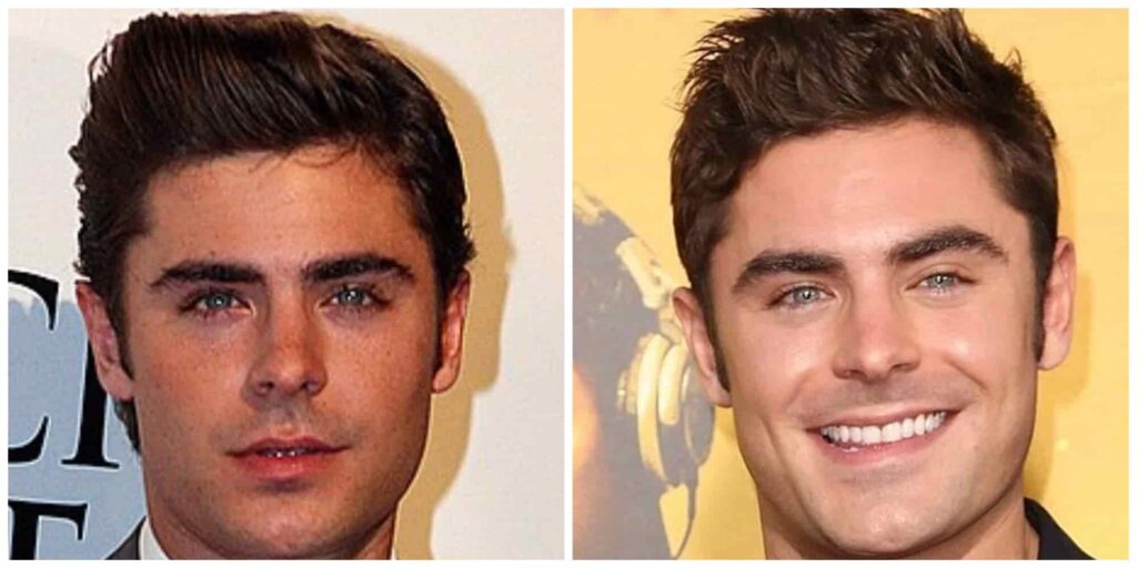 Zac Efron nose before and after