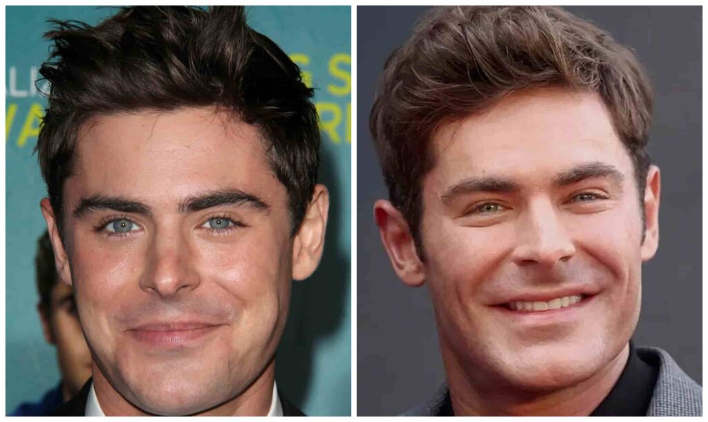 zac efron before and after plastic surgery alleged