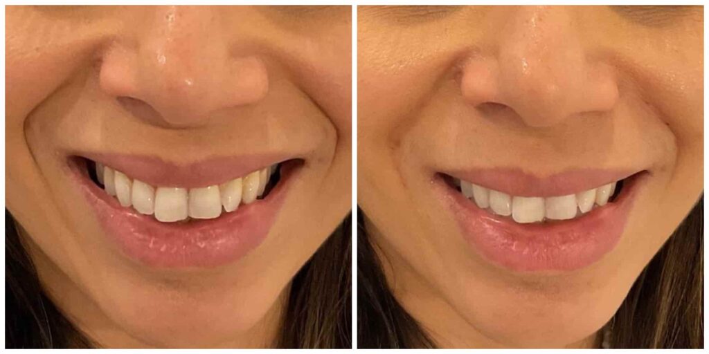 Nasolabial filler before and after