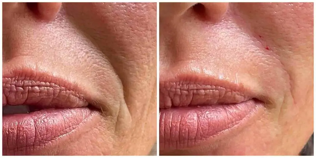 Nasolabial fold fillers results