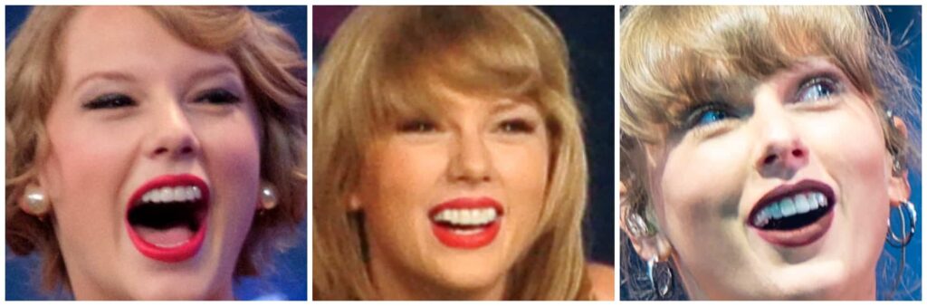 Taylor Swift teeth before and after