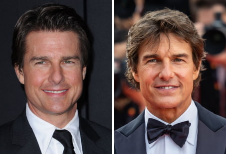 Tom Cruise alleged plastic surgery