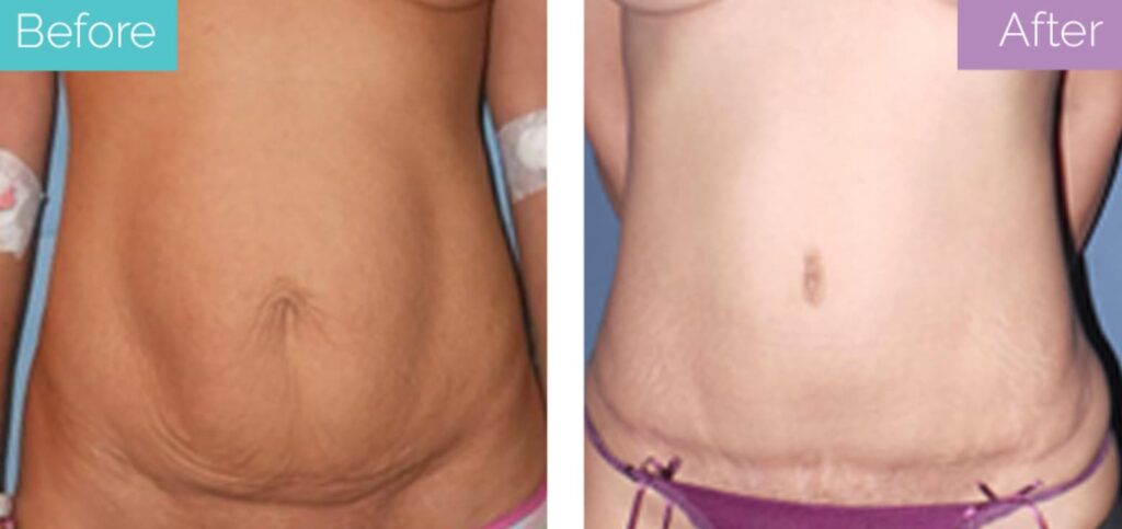 traditional tummy tuck incision