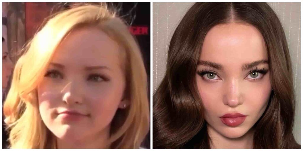 Dove Cameron lips before and after