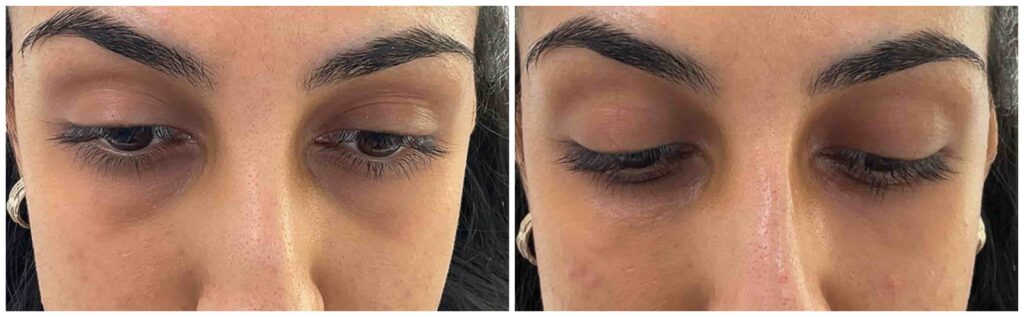 tear trough filler before and after