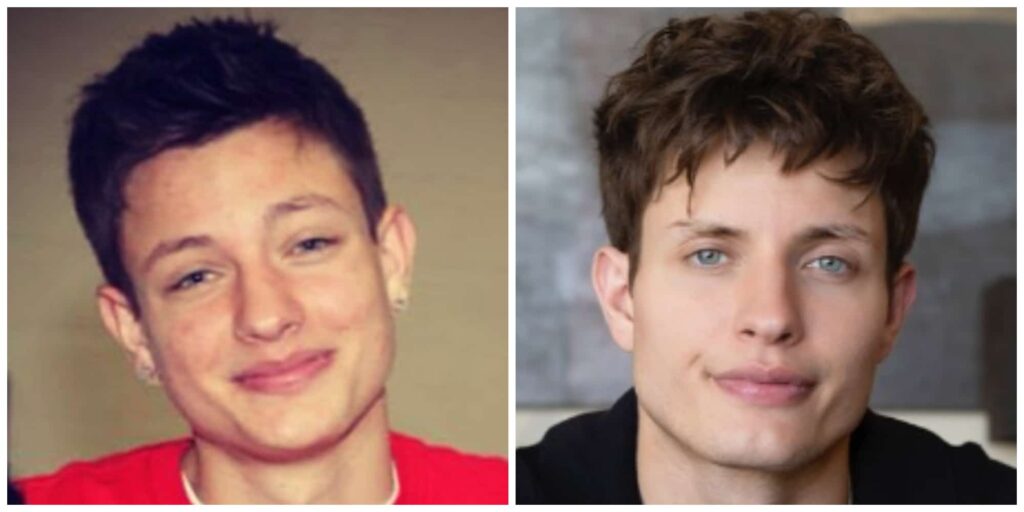 Matt Rife cheeks before and after