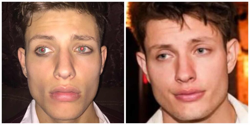 Matt Rifes jawline before and after