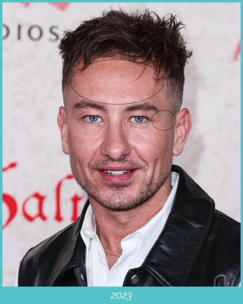 Experts Say: Barry Keoghan Might’ve Had Cosmetic Treatments