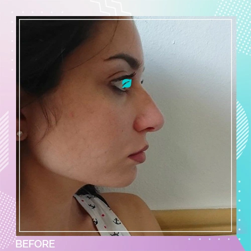 nose job patient 7 before