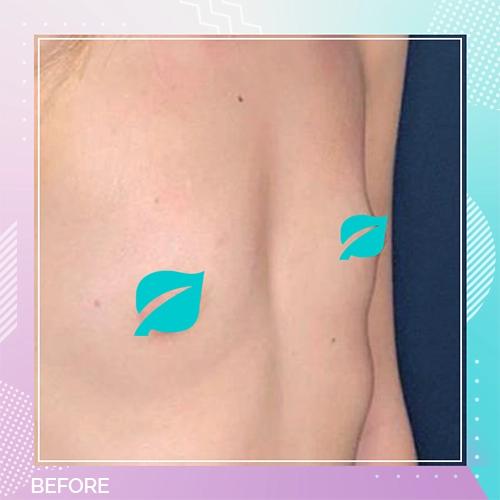 Breast Implant Patient 1 Before