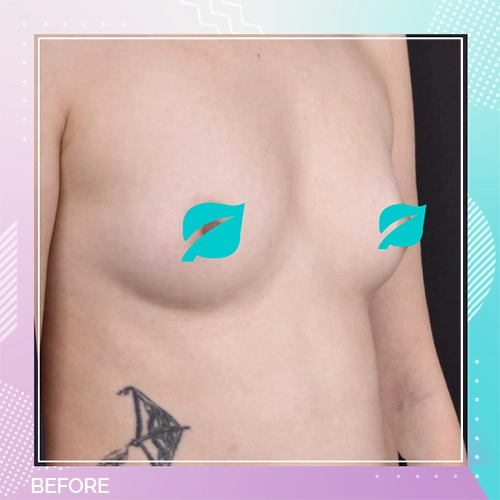 Breast Implant Patient 10 Before