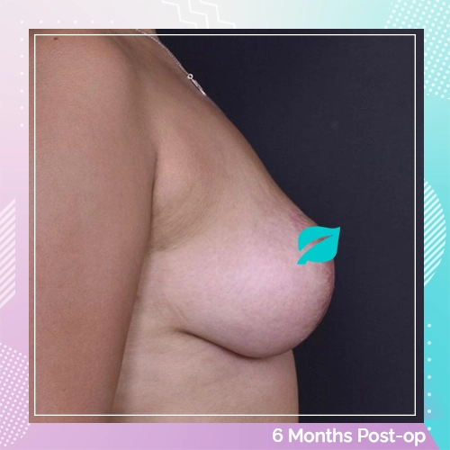 Breast Uplift Patient 4 After
