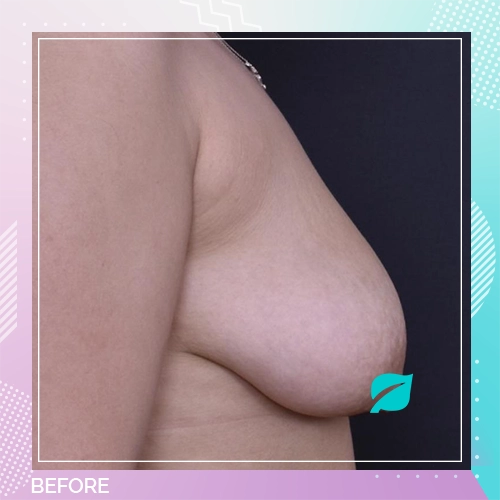 Breast Uplift Patient 4 Before
