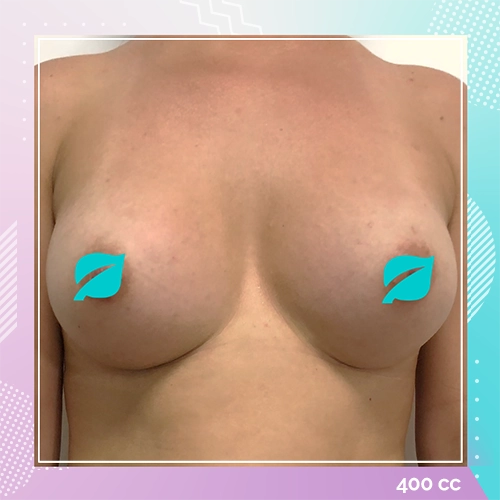 Breast implant patient 8 after