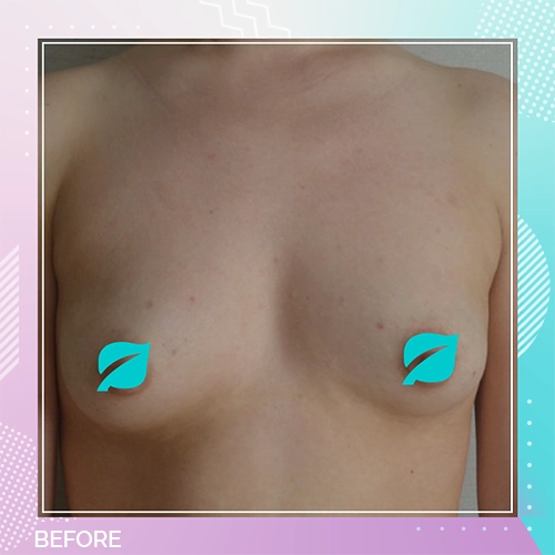 Breast implant patient 8 before