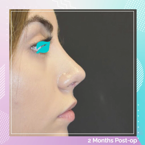 Nose Job Patient 14 after
