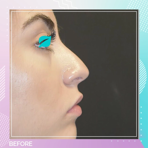 Nose Job Patient 14 before