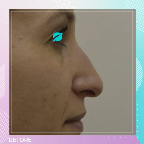 Nose Job Patient 15 before