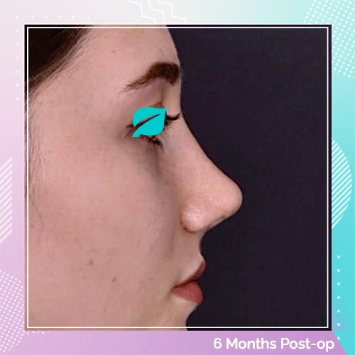 Nose Job patient 1 After