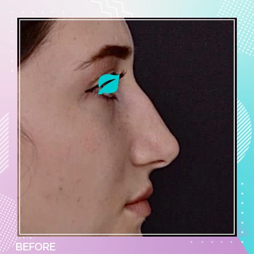 Nose Job patient 1 Before