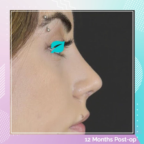 Nose Job patient 3 After