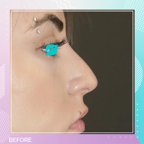 Nose Job patient 3 Before