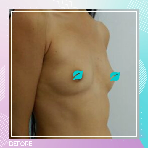 breast implant patient 11 before